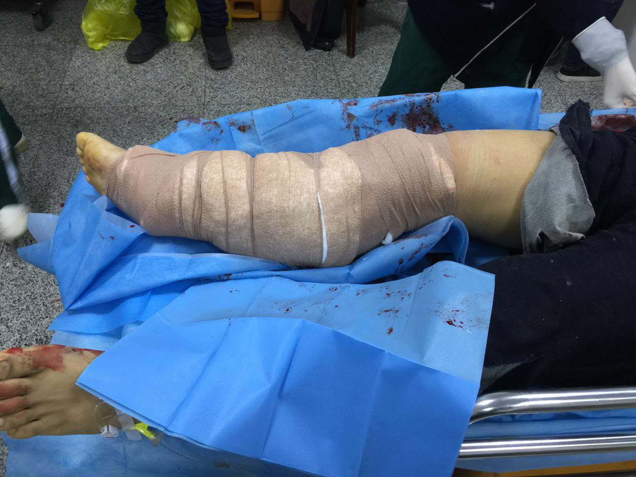 急诊科成功救助车祸小腿毁损伤患者