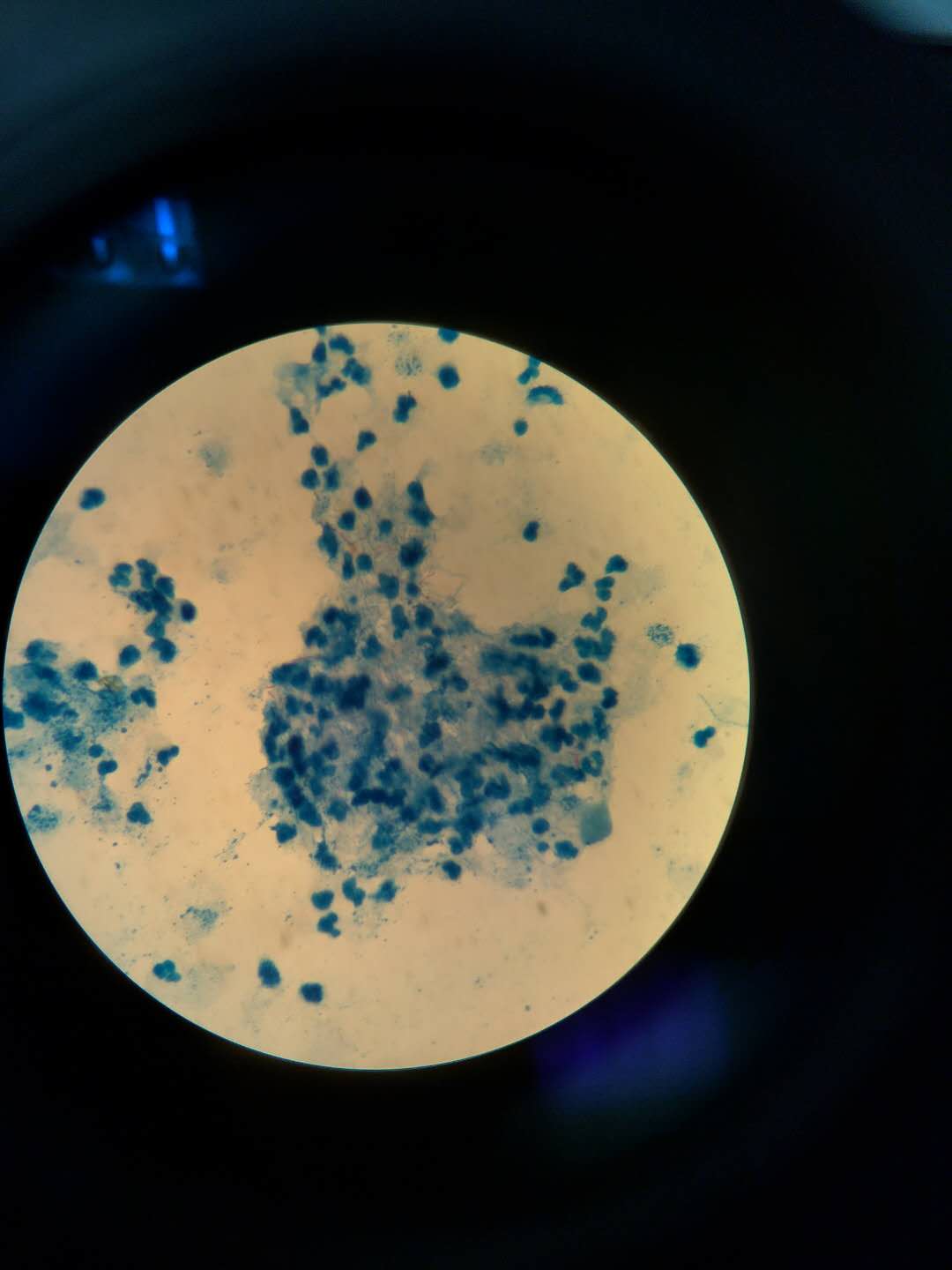 检验科成功协助临床医生诊断全身播散性诺卡菌感染一例