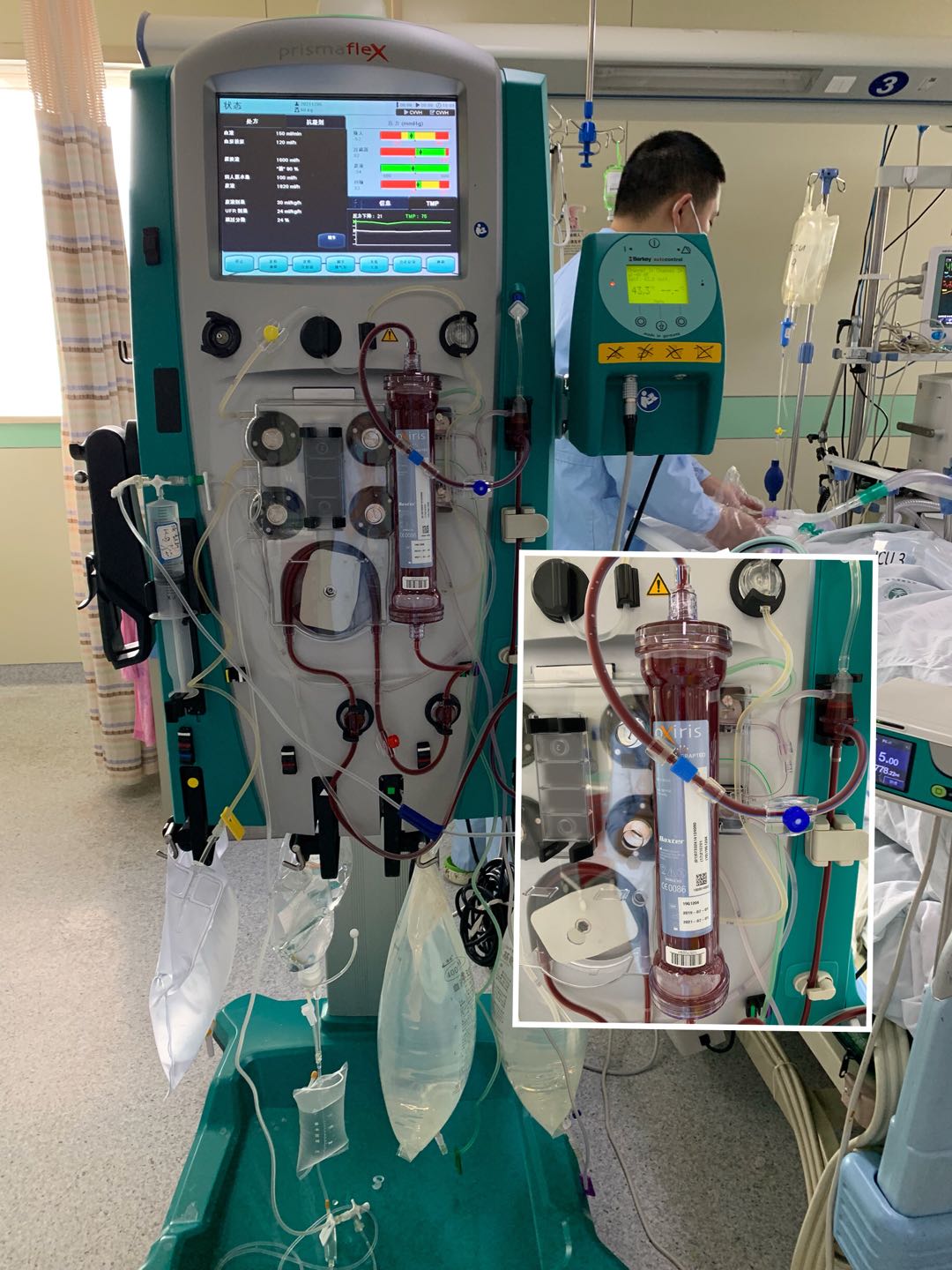 近日,我院重症医学科crrt团队为一位并发感染性休克的腹膜炎患者实施