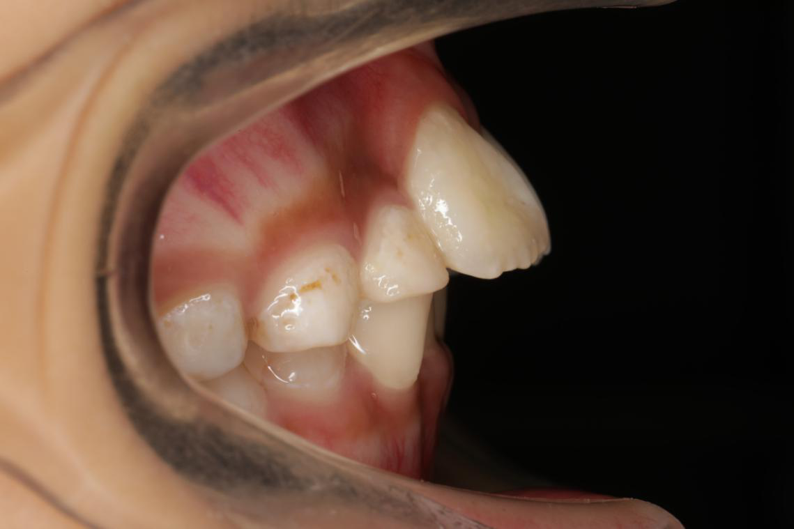 aao认为,儿童错牙合畸形的早期矫治有助于儿童:(1)上,下颌骨更协调的