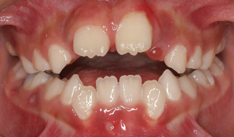 畸形的早期矫治有助于儿童:(1)上,下颌骨更协调的生长;(2)避免因牙齿