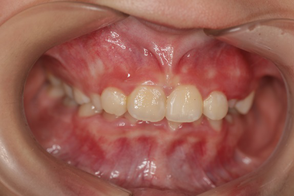 儿童错颌畸形早期矫治的那些事儿