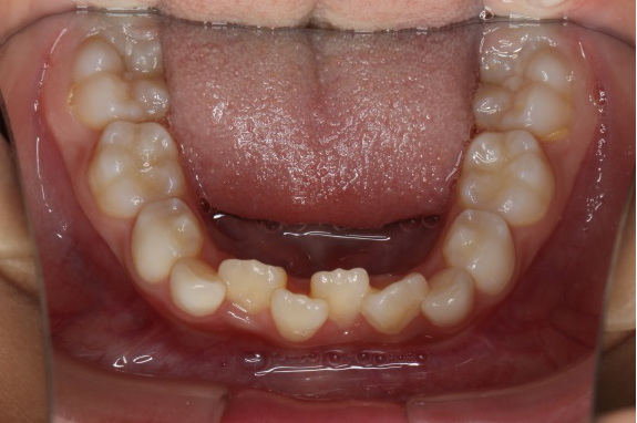 aao认为,儿童错牙合畸形的早期矫治有助于儿童:(1)上,下颌骨更协调的