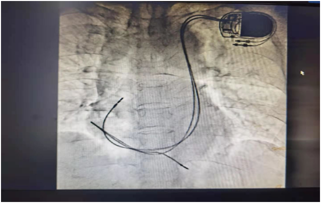 我院成功为永存左上腔静脉患者植入双腔心脏起搏器