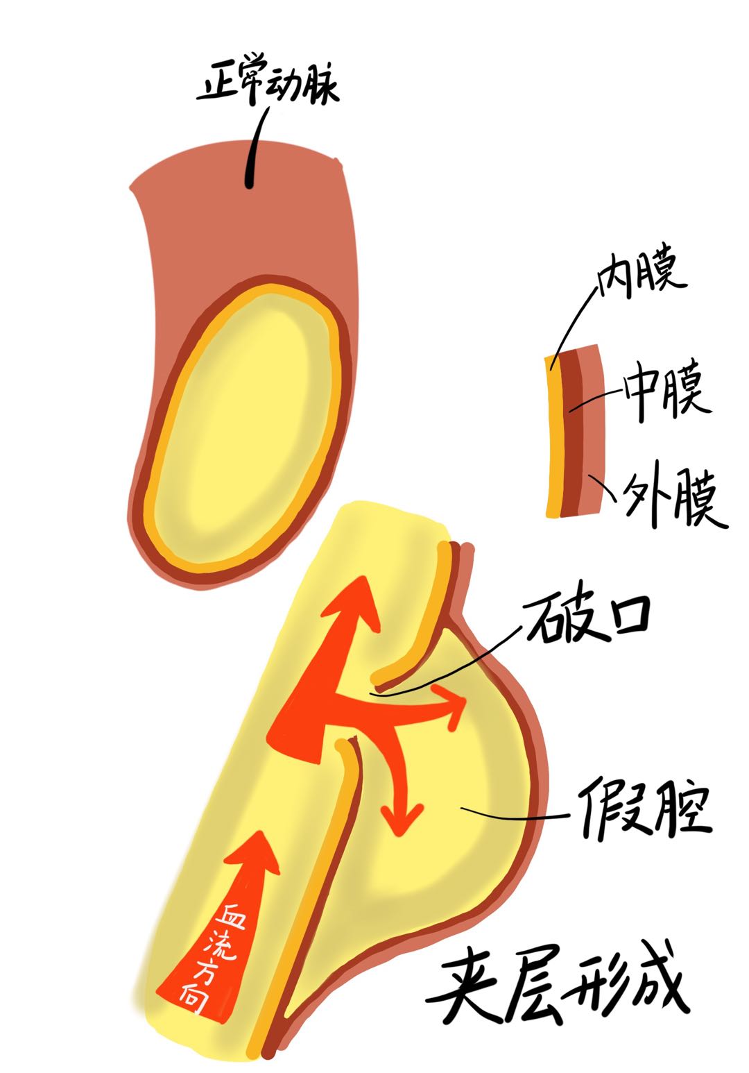 胸心外科成功为91岁高龄主动脉夹层患者拆除"定时炸弹"