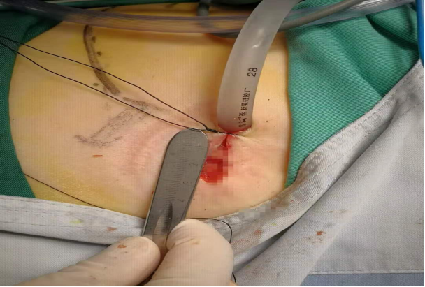 我院胸外科完成乐山地区首例单孔胸腔镜下肺袖状切除术