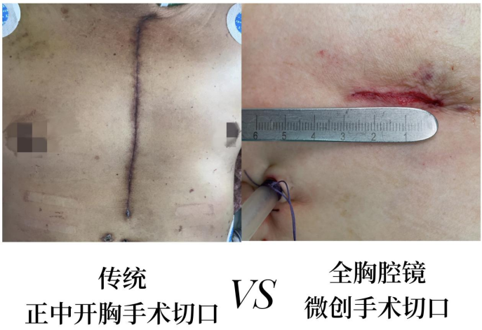 血管外科成功独立开展省内首例胸腔镜辅助vats微创心脏联合瓣膜置换术