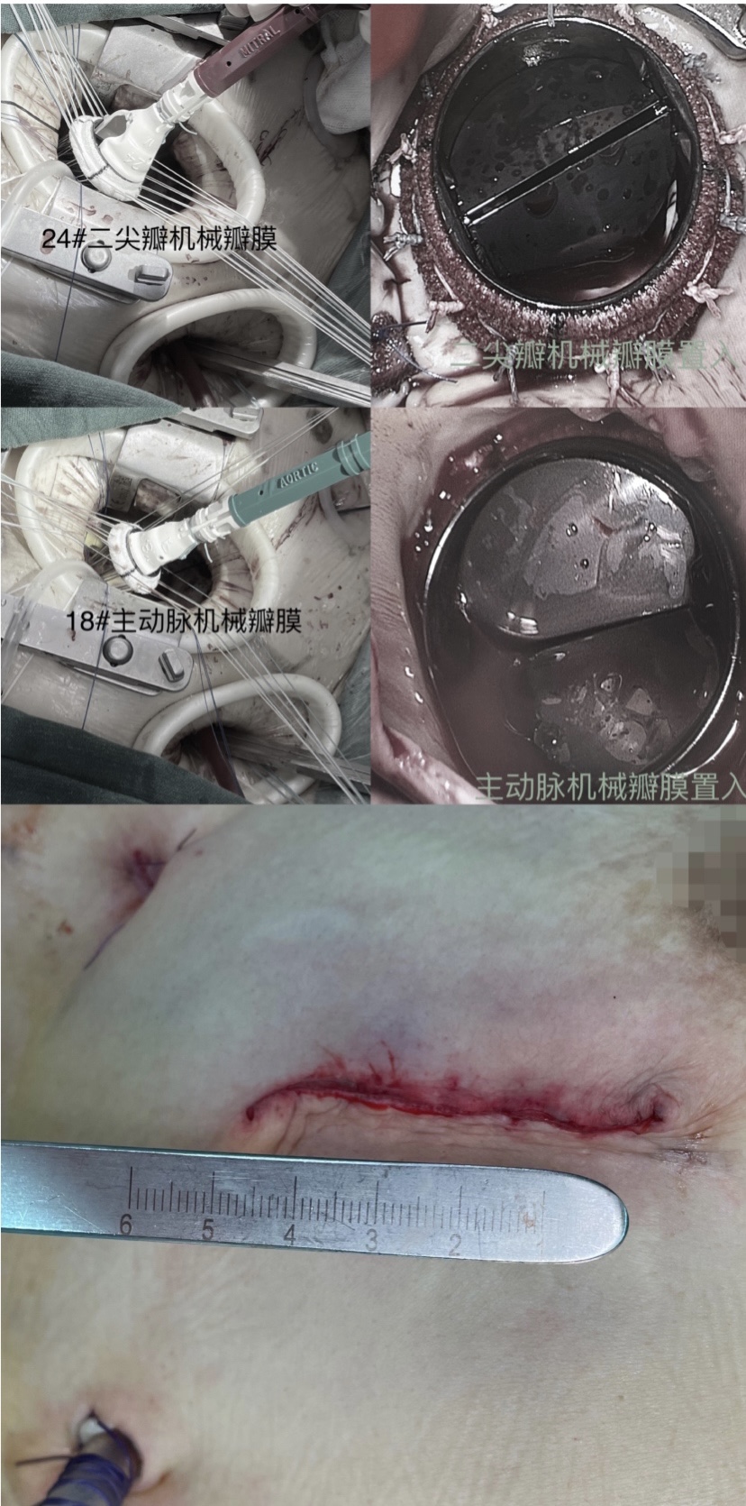 我院心脏大血管外科成功独立开展省内首例胸腔镜辅助vats微创心脏联合