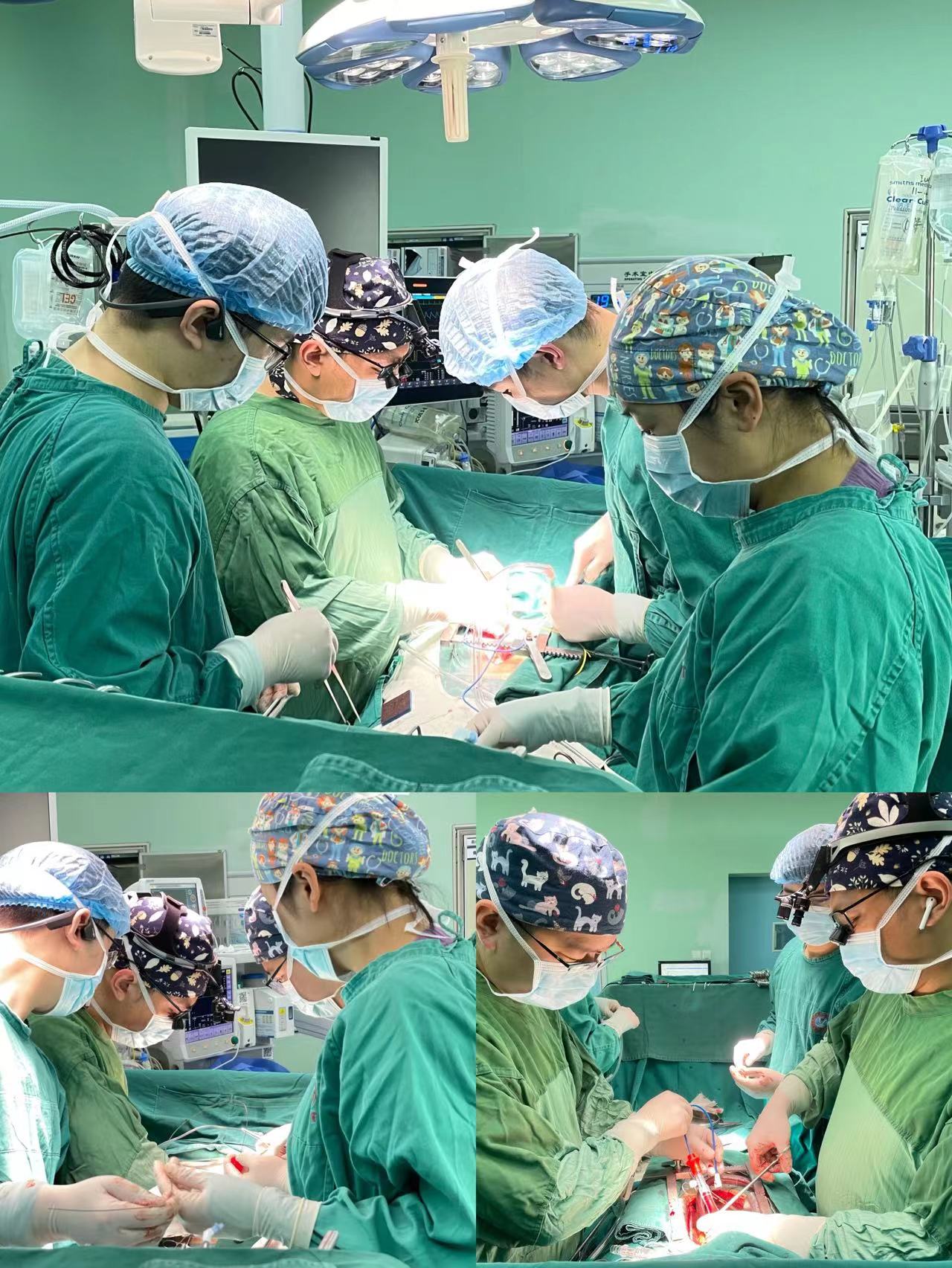 奋战6小时,凭借硬核的专业技术,顺利完成了一例a型主动脉夹层孙氏手术