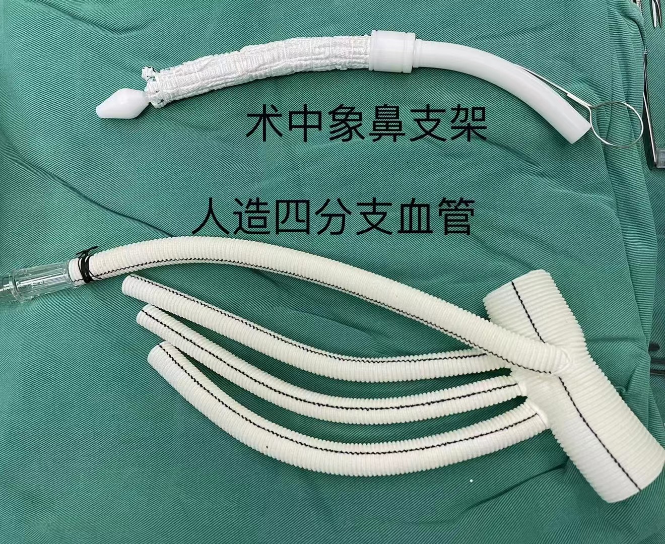 青年女性突发a型主动脉夹层心脏大血管外科连夜紧急手术成功拆弹