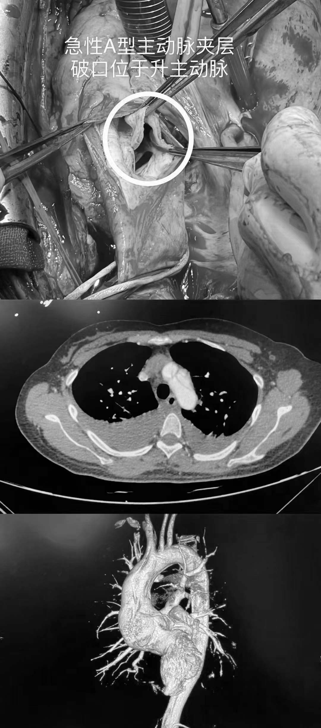 马不停蹄地为刘女士实施了急诊右冠主干冠脉搭桥术 bentall手术 孙氏