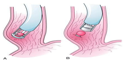 3,胃底静脉曲张组织胶注射术:复诊:1,原则遵医嘱定期消化内科专病门诊