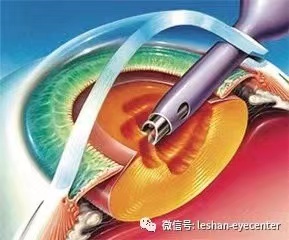 白内障.jpg 白内障.jpg