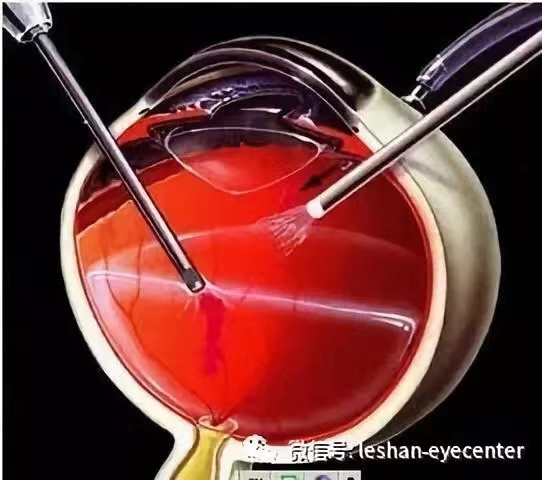 眼底外科.jpg 眼底外科.jpg