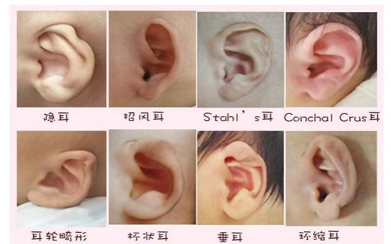 耳廓畸形.jpg