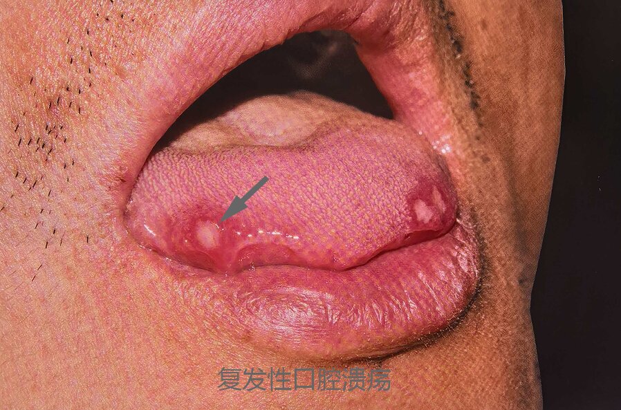 轻型复发性阿弗他溃疡.jpg